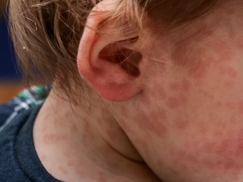 Ante la confirmación de un caso de sarampión, Salud convocó a comisión de vigilancia